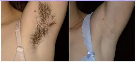 腋下脱毛_整形频道_寻医问药网