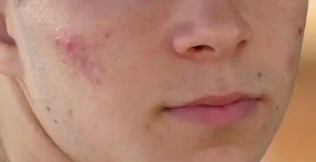 6,鼻子上的痤疮反复发作,毛血管扩张,皮肤开始增生性肥厚,呈"橘皮状"