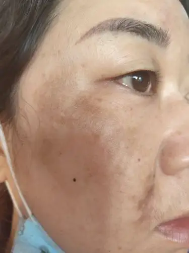 真皮斑的全过程