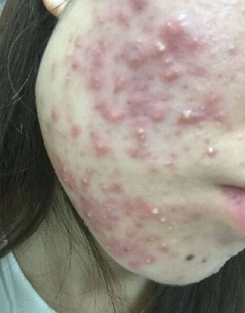 痤疮皮肤图片 - 实验室设备网