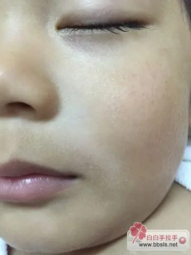 麻烦博士看下孩子的情况,这个是白色糠疹吗?需要治疗吗?