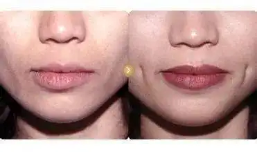 酒窝甜美可爱但人造酒窝能不能做呢