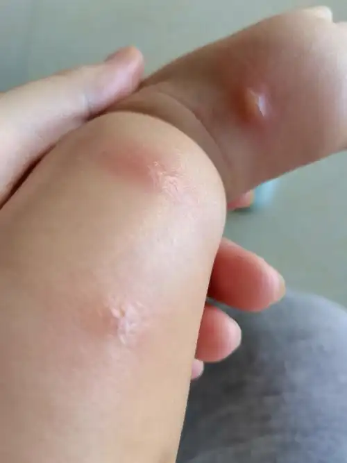 可恶的蚊子宝宝脚被咬三口就变成这样了咋整呢