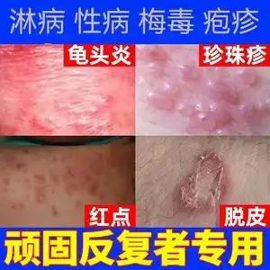 治疗淋病性病一扫光包皮炎龟头炎梅毒男女性病克星喷剂私处药膏