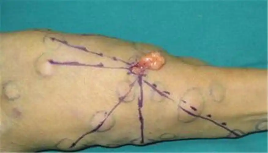 手臂脂肪瘤手术后图片