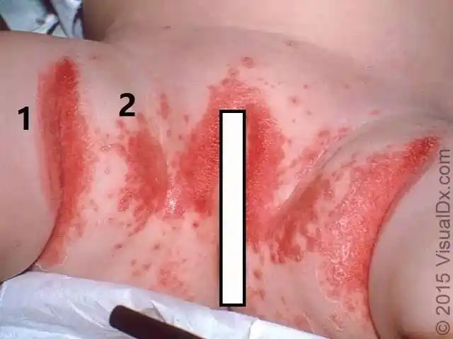 keroo纸尿裤分享宝宝红屁屁知多少