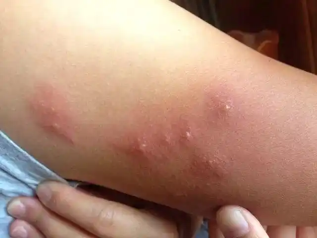 蒙特利尔公交车上惊现让人闻风丧胆的吸血臭虫一旦被咬后果很严重