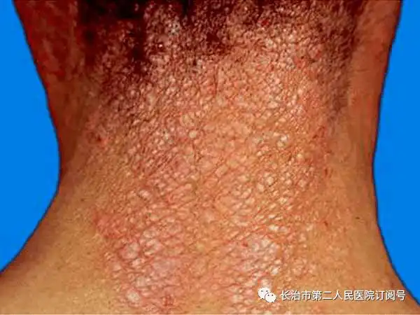 二院医生说皮肤瘙痒难忍小心神经性皮炎