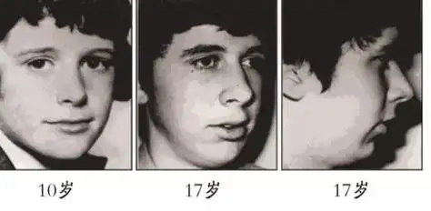 拉低儿童颜值的『腺样体面容』!睡觉打鼾,张口呼吸的孩子都要警惕!