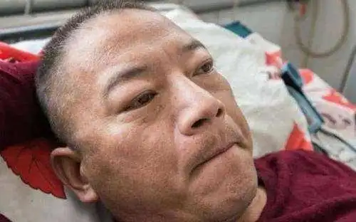 原创尿毒症到来时,头上会出现3迹象,肾脏或已受损!