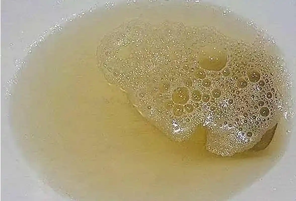 我一般都会建议他去看一下,尿液的泡沫,是不是很快消失.