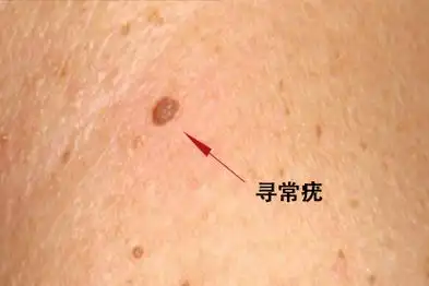 脖子上尖锐疣图片是什么样_名医在线