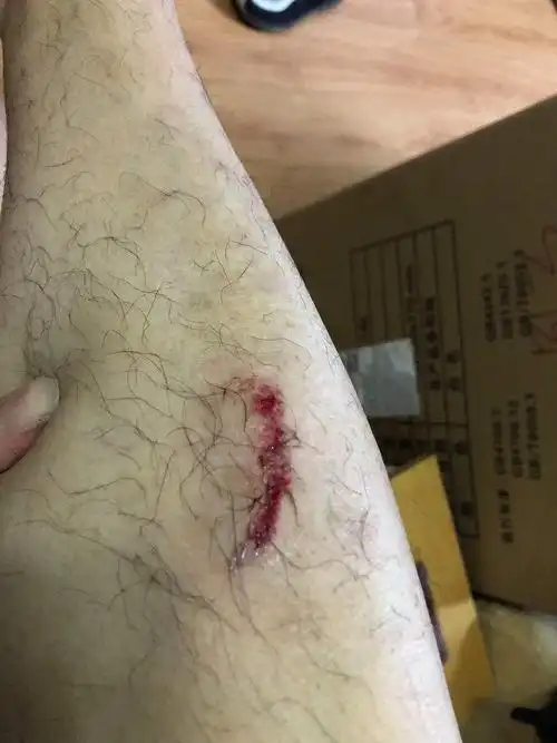 今天骑车,摔了一下,腿摔伤了破皮了,怎么样才能好的快 并且里面还有灰