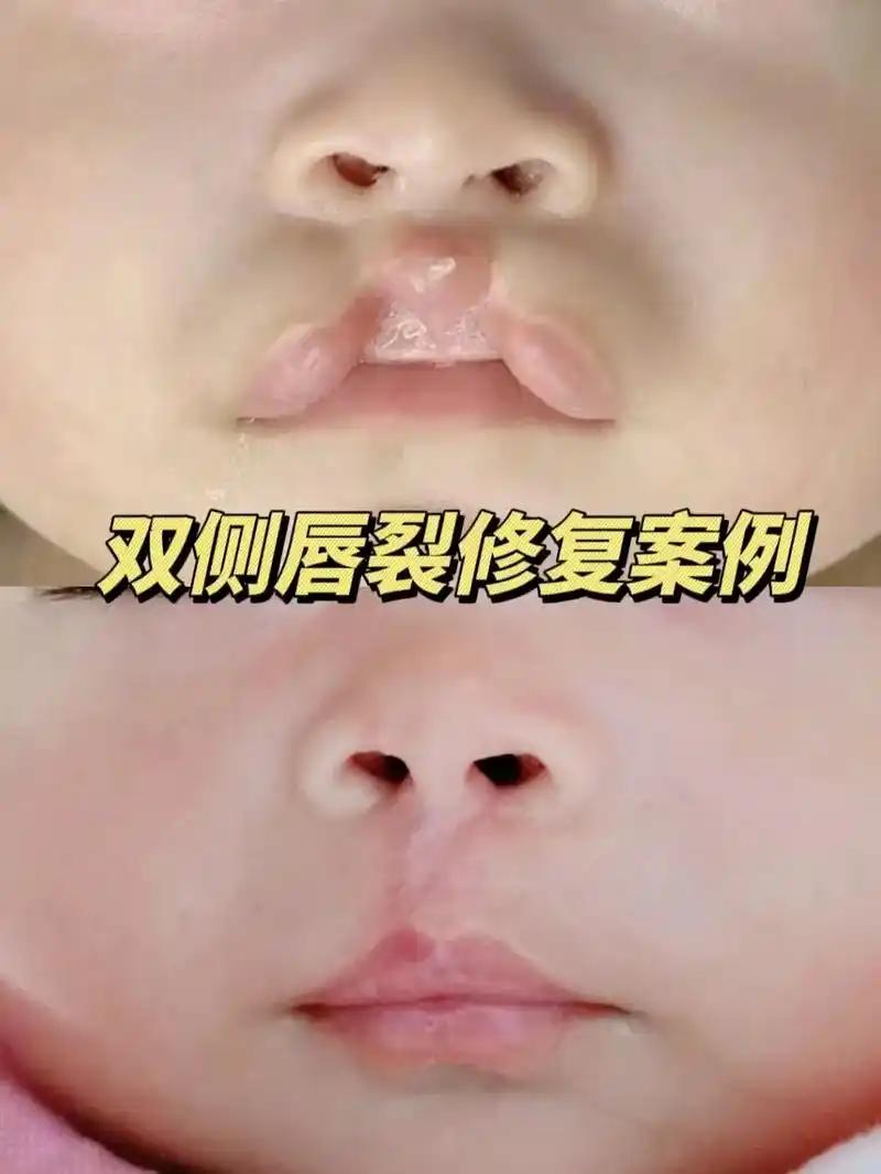 双侧唇裂的宝宝也能拥有天使般笑容.
