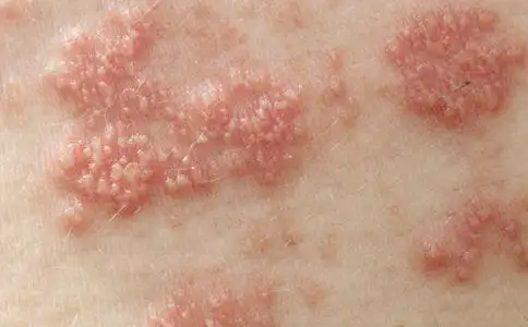 疣状增殖,疣状指一种皮肤表面赘生物的形状,多表现为突起状,因形似疣