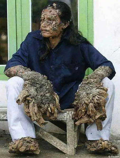 舌头上长疣图片