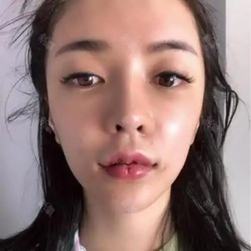 我这个唇形,已经不满意很久了,我是天生厚唇,上唇_圈子-新氧美容整形