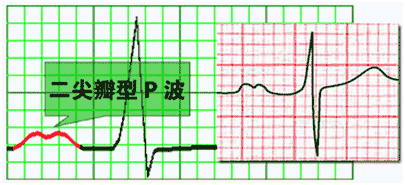 p波增宽≥0.12s,其振幅≥0.25mv.