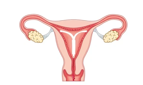 上曼月乐环后出现非经期不适怎么办?_子宫