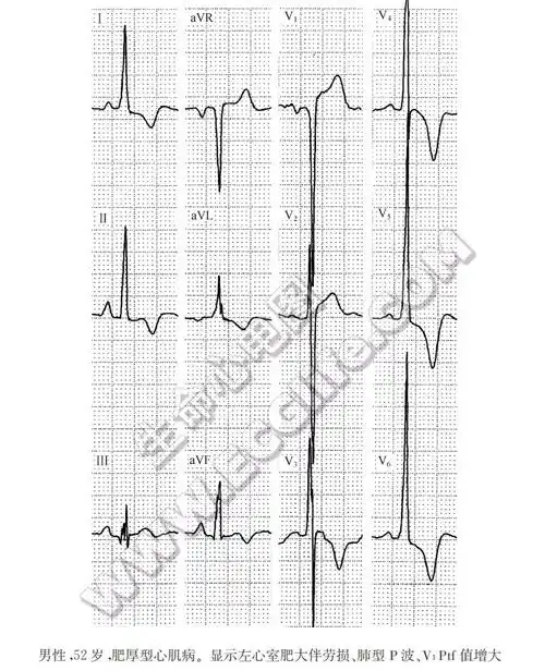 显示左心室肥大伴劳损,肺型p波,v1ptf值增大(心电图)