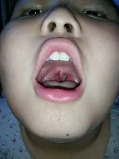 他扁桃体肥大,就是晚上睡觉时打呼噜严重.