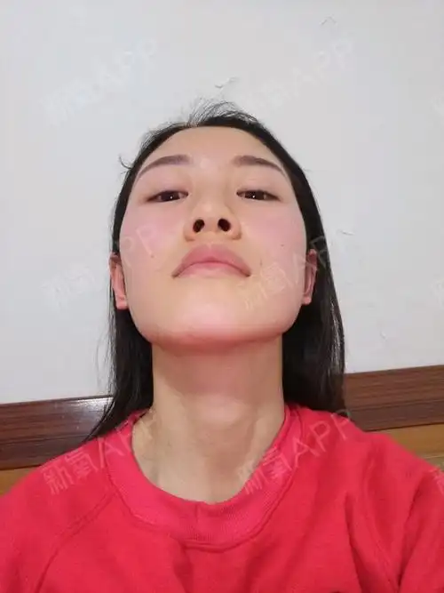 下颌角歪斜,有过模特经历,但是自信心受到了很大的创_圈子-新氧美容