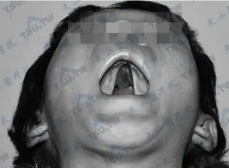 腭裂儿童的护理