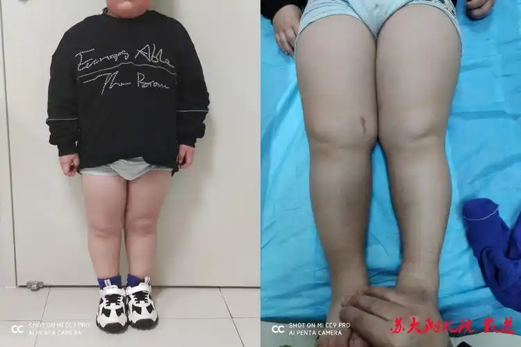 病例随访-膝外翻畸形的微创手术治疗 - 好大夫在线