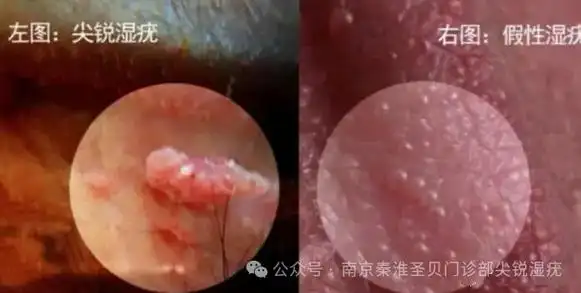 尖锐湿疣真假对比图片_试验_醋酸_结构