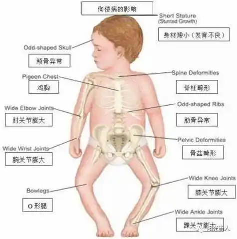 维生素d缺乏性佝偻病