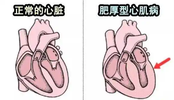 肥厚型心肌病  以未知原因的左心室肥厚为特征,可以继而引发心衰