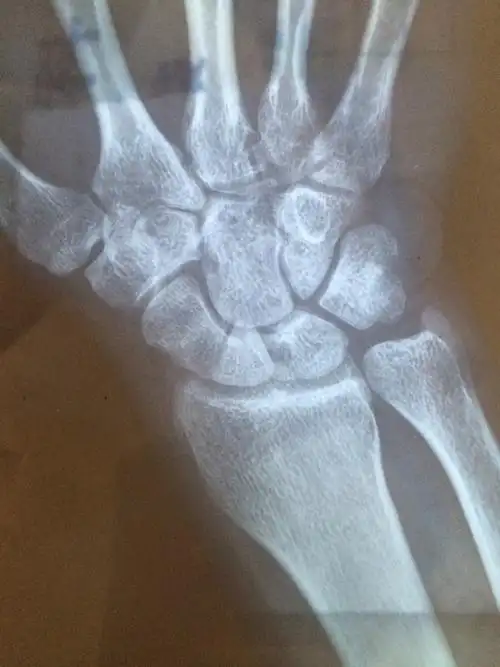 右手舟状骨断裂四十多天了,之后拍的照片,医生帮我看看涨了没有,我