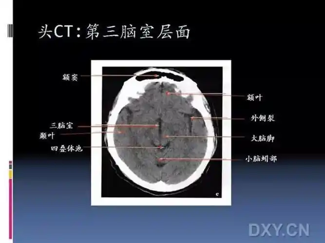 10张图搞定正常头颅ct断层解剖