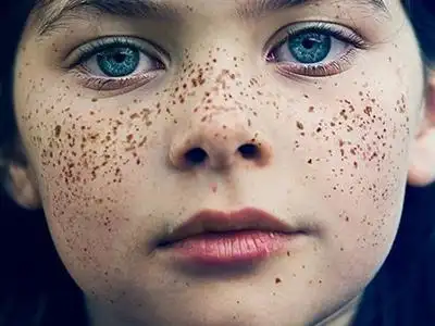 七岁的男孩脸上长了些遗传雀斑怎么办啊