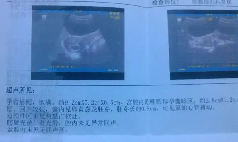 50天b超,孕囊为2.8cm*1.2cm*3.4cm 是男宝女宝啊,请