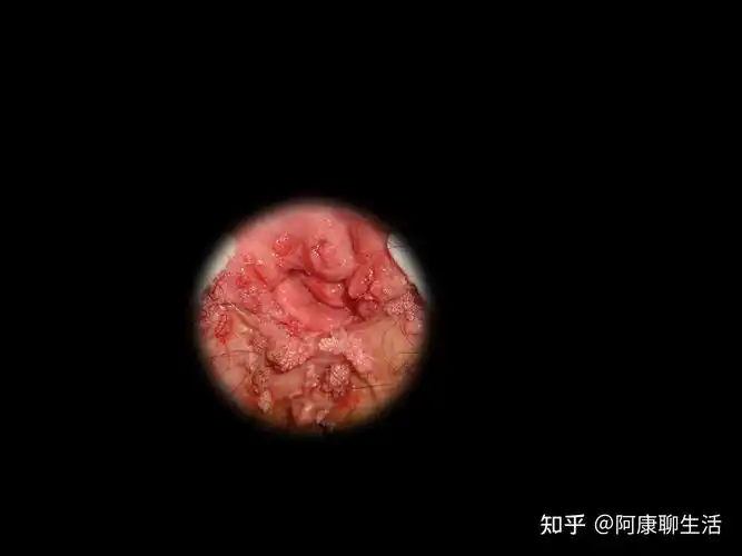 会阴长了个菜花状疣体