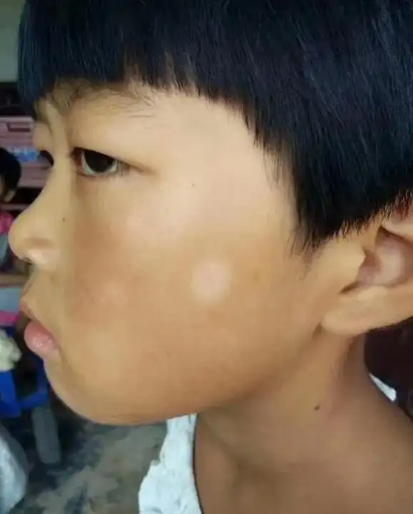 或可疑患者 知 花斑癣治疗前 级发热门诊 目发热等可疑患 珍 - 抖音