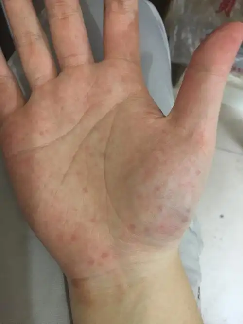 最近才出现的手掌热的时候红点更多请医生看看是怎么回事