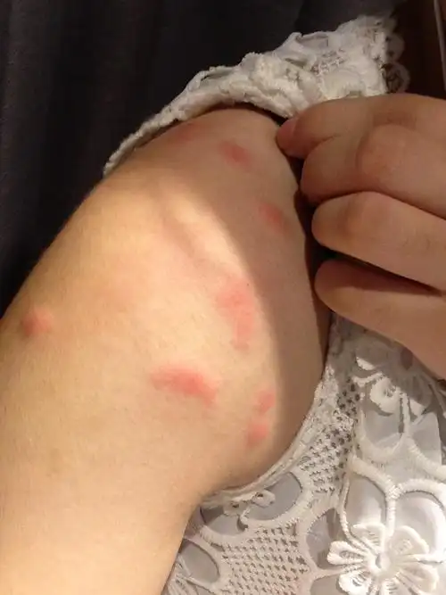 肩膀上一圈红疙瘩,很痒!