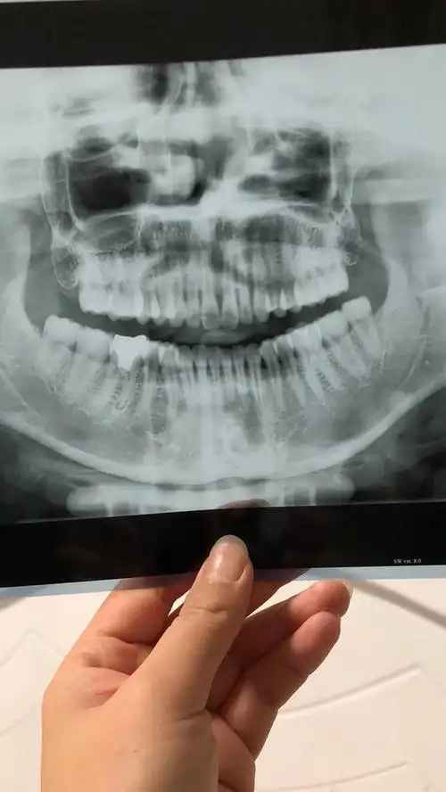 把在医院拍的片子拿回家做装饰了09