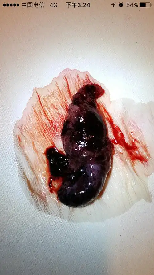 自然流产图片赏析原创