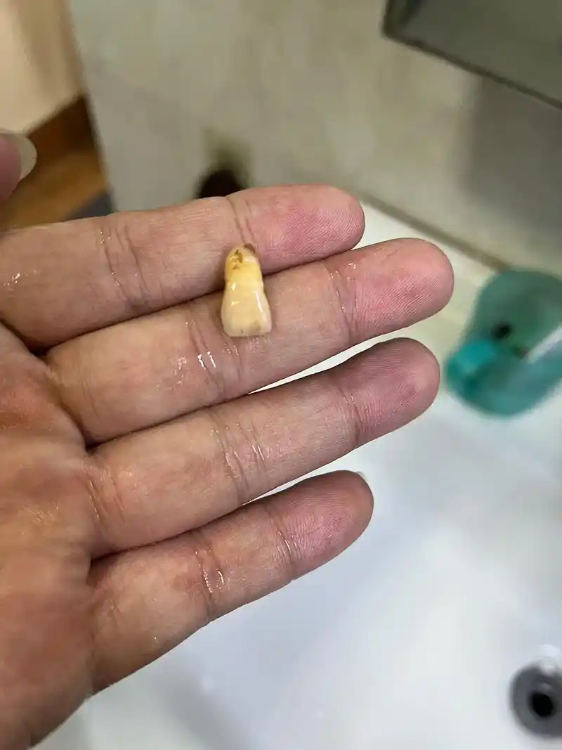 门牙都掉了,想去种牙,牙科诊所又未上班,点样见人989898 - 抖音