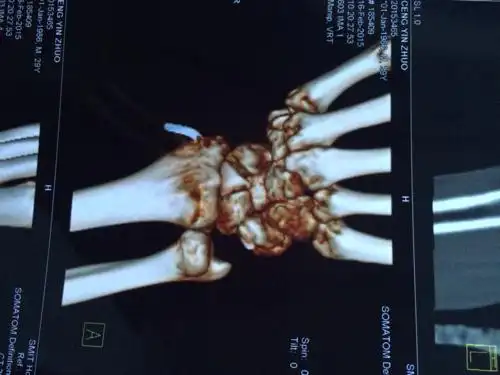 问1.多发性骨折处有愈合迹象吗?2.多久