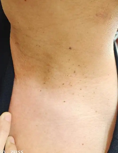 67脖子上的小肉瘤其实是它——丝状疣-健康科普-邯郸中信皮肤科