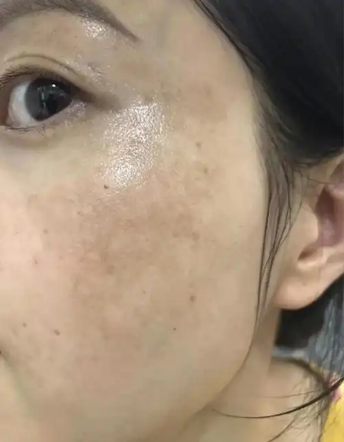 对于黄褐斑来说,把身体的机能调节到正常的健康状态,同时搭配使用一些