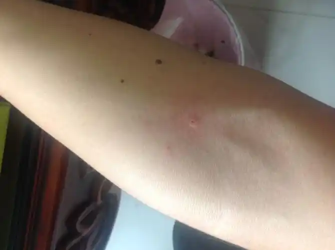 10分钟前被疑似恙虫的小虫子咬到了,感觉像蜜蜂叮的一样,伤口尝试用针