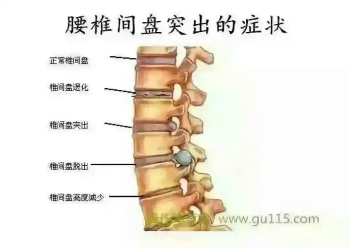 梯玛黑膏贴—腰间盘突出篇
