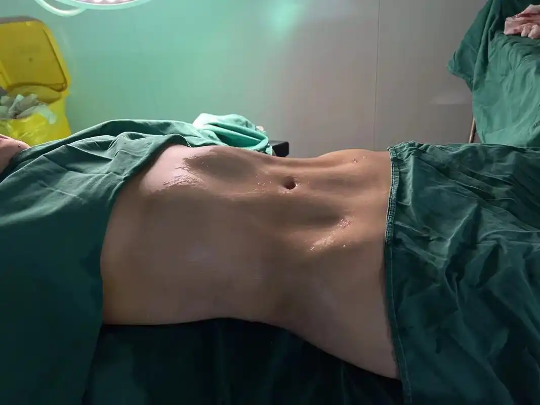 二十多年的老同学老朋友,大老远来上海,亲自打造腰腹环吸77马甲