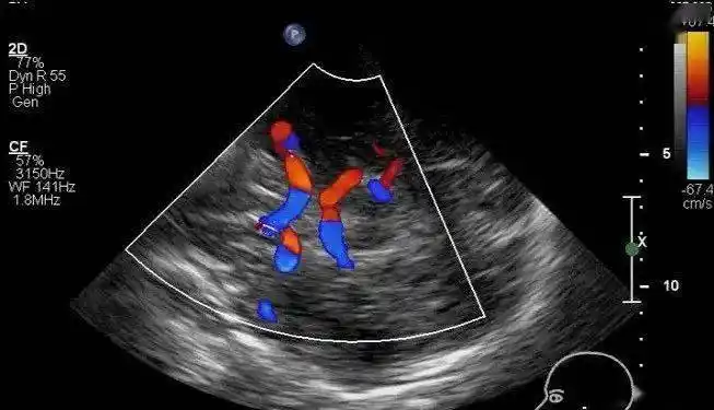 用超声看清脑血管