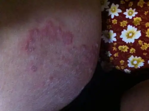 生殖器周围长了很多大片的红块,稍微凸起